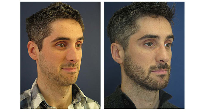 Rhinoplasty before and after photo