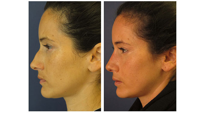 Rhinoplasty before and after photo