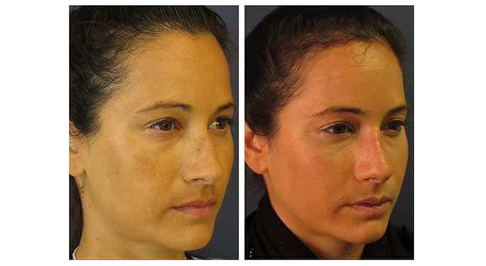 Rhinoplasty before and after photo