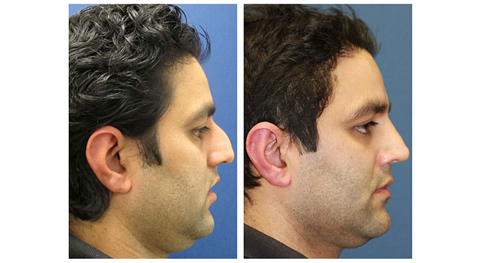 Rhinoplasty before and after photo