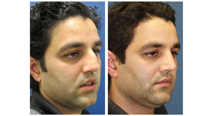 Rhinoplasty before and after photo