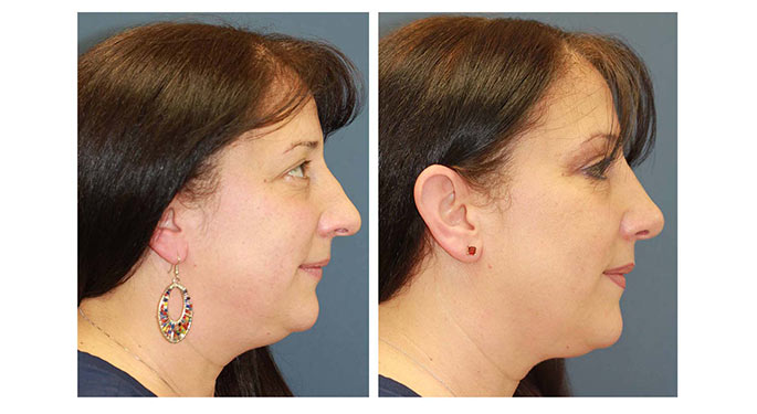 Rhinoplasty before and after photo