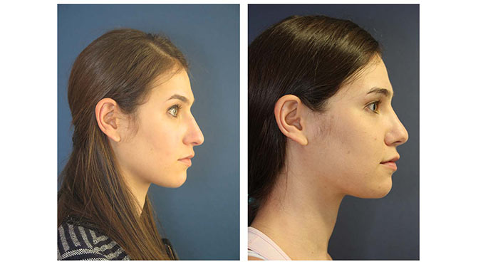 Rhinoplasty before and after photo