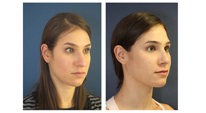 Rhinoplasty before and after photo