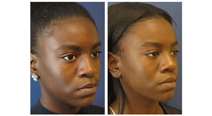Rhinoplasty before and after photo