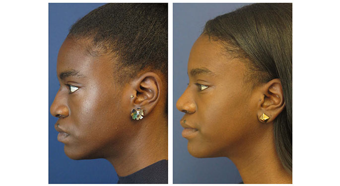 Rhinoplasty Austin Tx