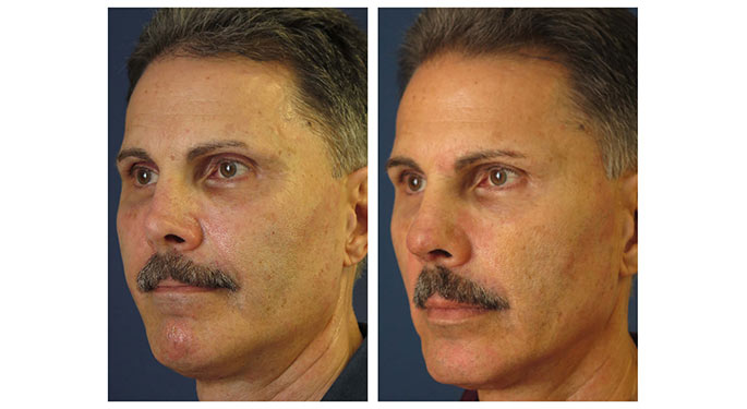 Rhinoplasty before and after photo