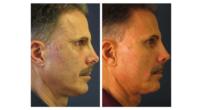 Rhinoplasty before and after photo