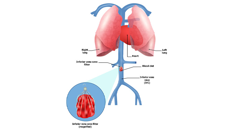 Illustration of IVC Filter