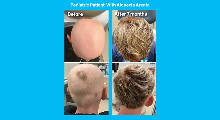 MSHS-Dermatology-AlopeciaAreata-2col-770x420-6.jpg