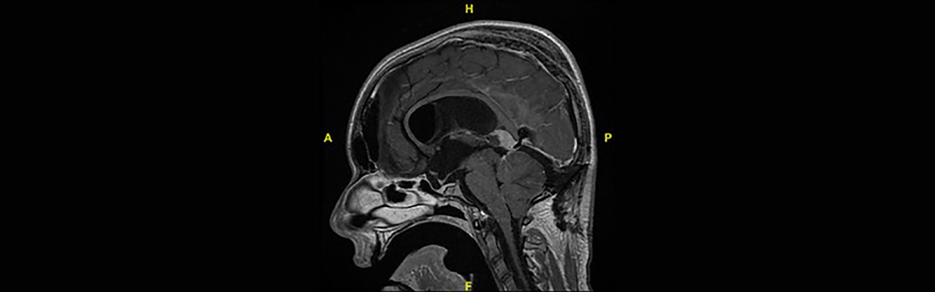 image of brain scan