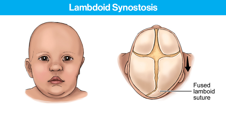 Lamboid Synostosis