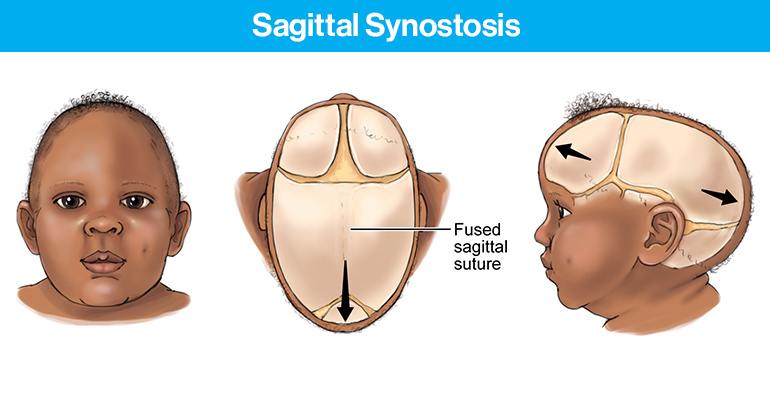 sagittal suture