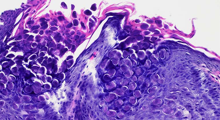 Ophthalmic Pathology