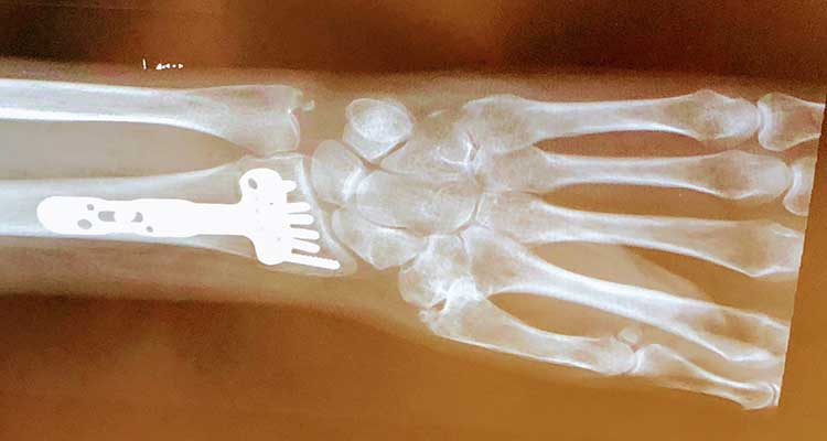 X-ray of wrist