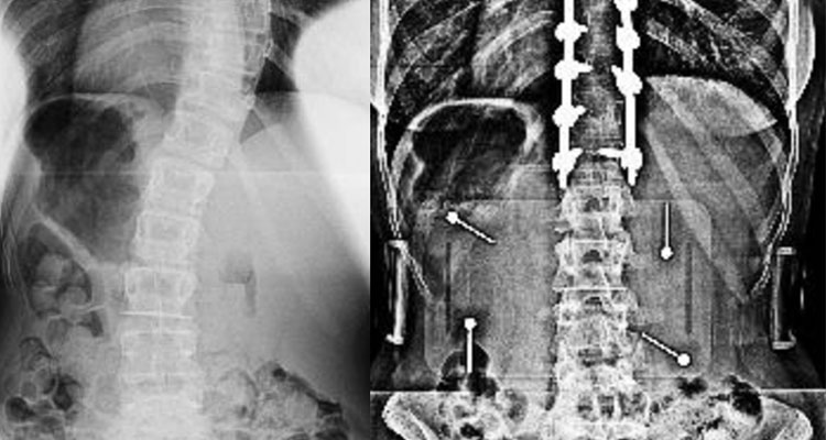 X-ray of spine