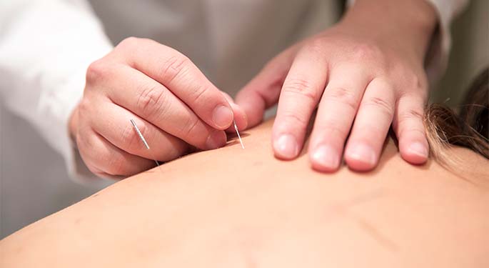 Doctor inserts short acupuncture needles into patient’s back
