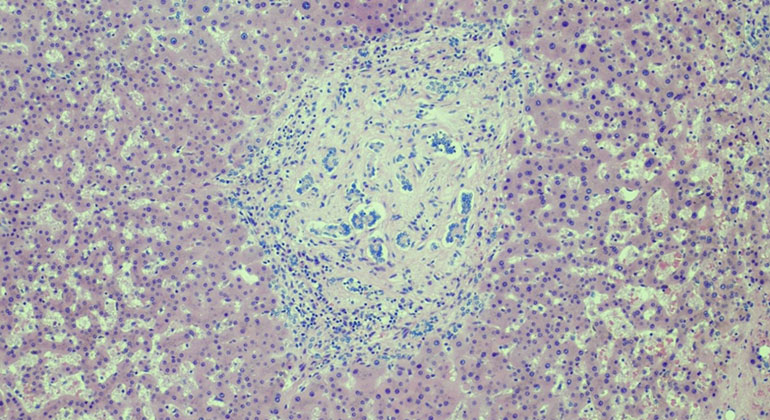 nodular regenerative hyperplasia