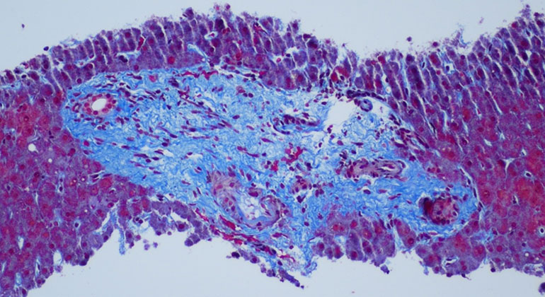 image of fibrotic portal tract