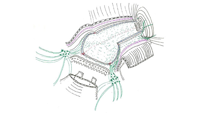 Sketch drawing of prostate