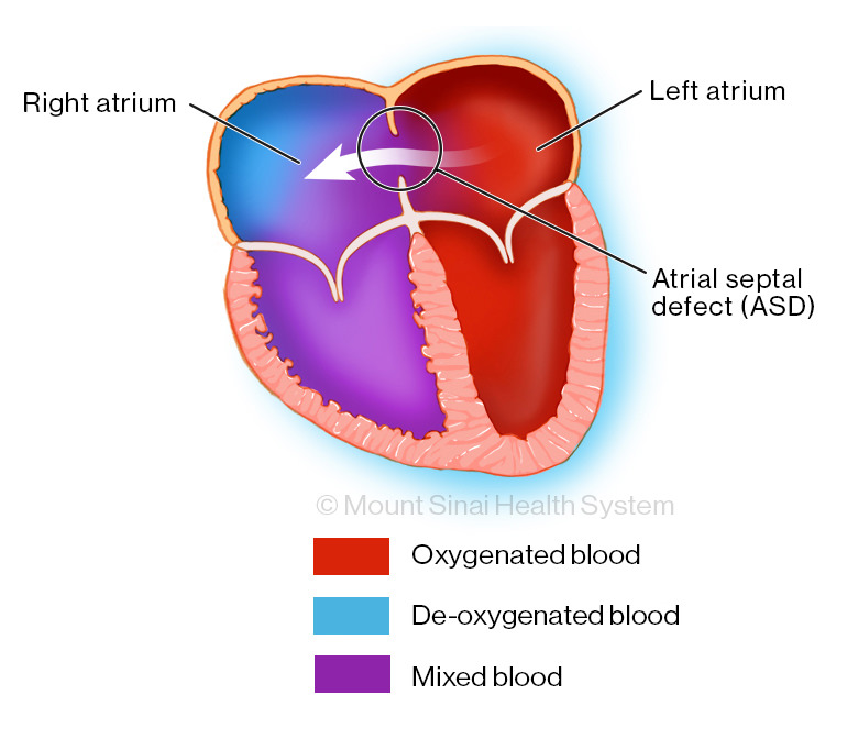 Pathophysiology Of Atrial Septal Defect In Flow Chart