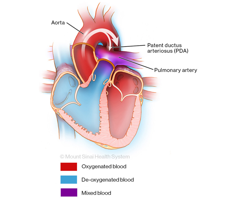 Blood vessel that remains open after birth illustration