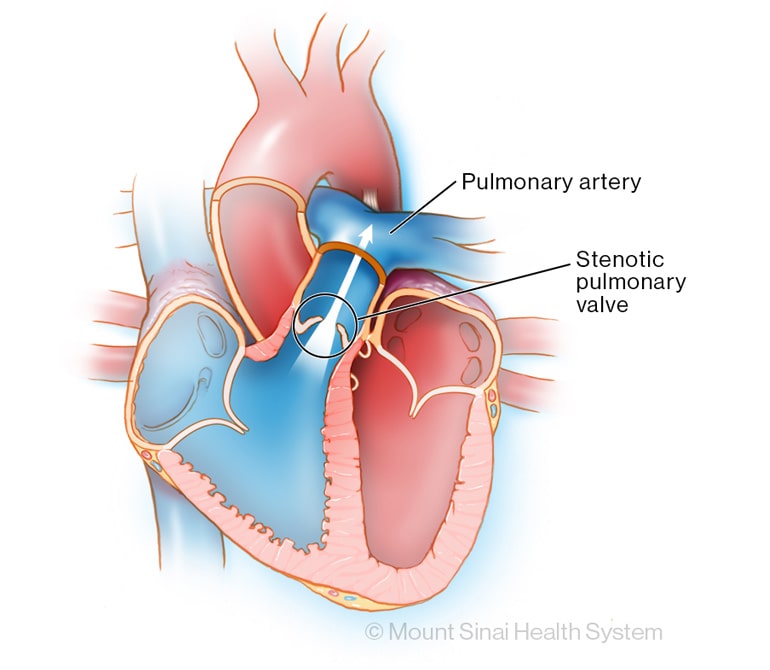 pulmonary valve