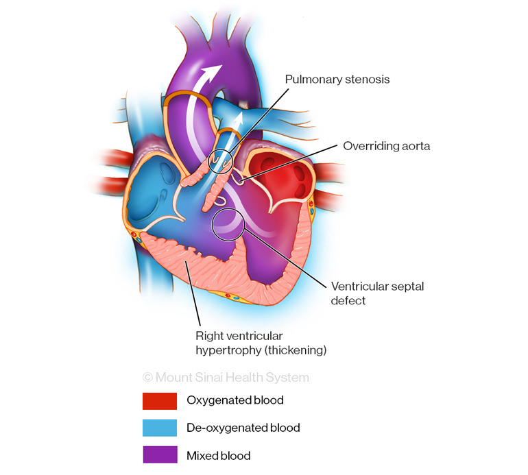 Tetralogy of Fallot Illustration