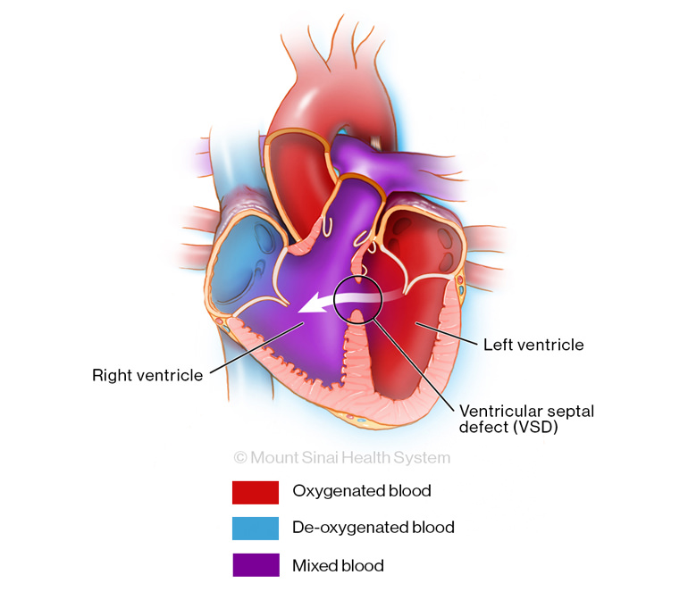 Unformed wall between the heart’s lower chambers illustration