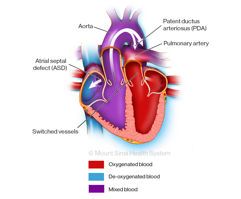 Transposition of the Great Arteries Illustration