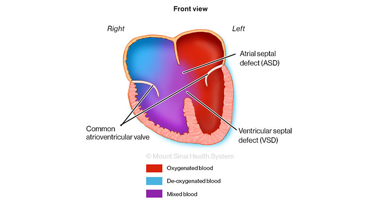 Illustration of Common AV Canal Front