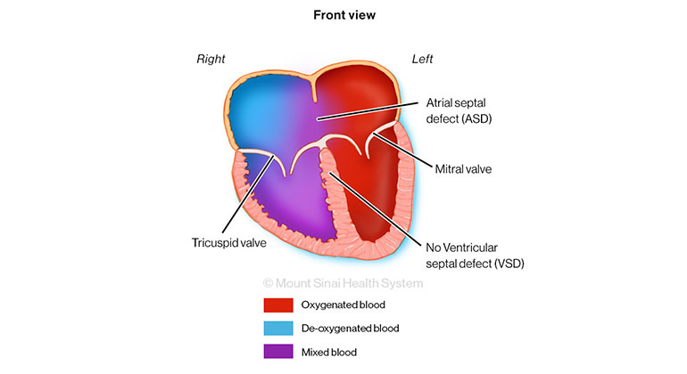 Illustration of Common AV Canal Partial Front