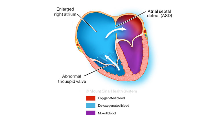 Illustration of Ebsteins Anomaly