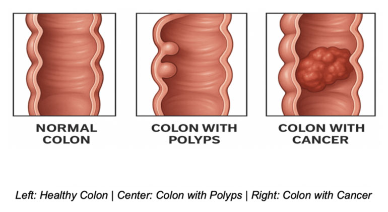 Colon Screening image