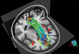 The Friedman Brain Institute