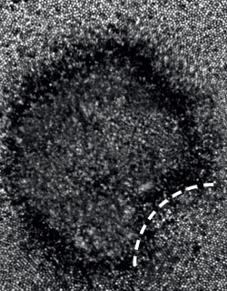 A confocal AOSLO image of a large area of abnormal and non-wave guiding photoreceptors in the shape of a moon crescent.