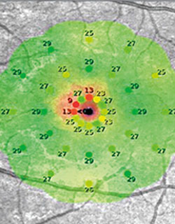 Microperimetry (CenterVue) showed multiple areas of decreased sensitivity paracentrally with a central absolute scotoma in the left eye