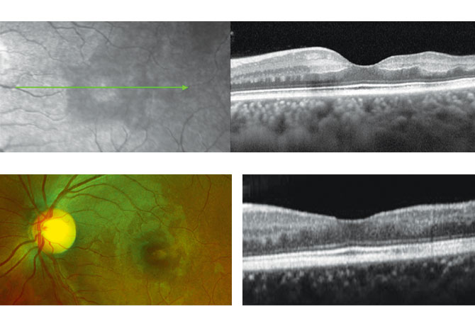 Above: Initial SLO and OCT image of left eye showing paracentral acute middle maculopathy and VA of 20/200. Below: Color fundus and OCT imaging 3-months post tPA shows improvement in vision (VA 20/20) and mild paracentral scotoma.