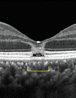 Spectral domain OCT (Heidelberg Engineering) showed abnormal near full-thickness hyperreflectivity at the center of the fovea, with hyporeflectivity of the outer segment and interdigitation zone.