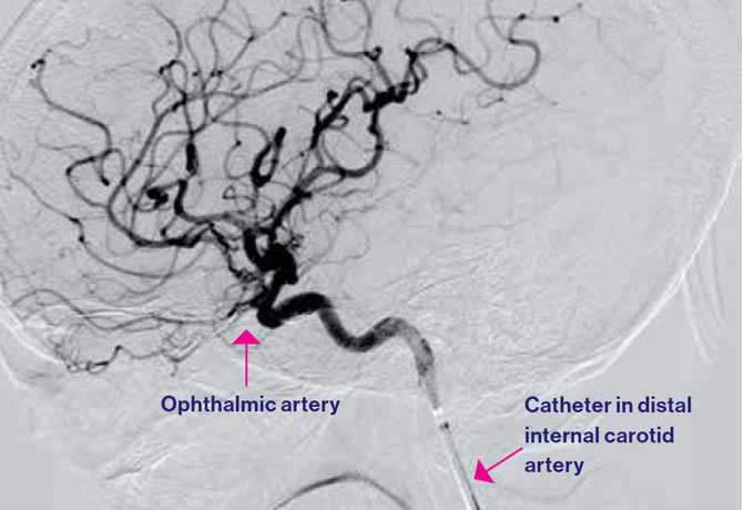 Angiogram of a catheter being guided by an interventional radiologist into the distal cervical internal carotid artery to administer tPA (22 mg) into the ophthalmic artery.
