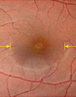 Fundus image of fovea of the left eye revealed a yellow-white spot