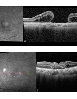 Two photos showing OCT images of the left eye before and after transplant.