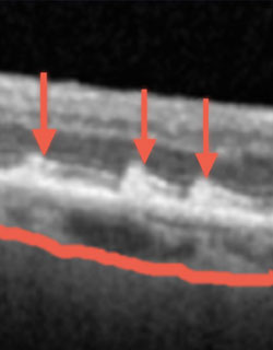 A high-resolution SD-OCT scan of macula in patient with coronary artery disease (CAD). Orange line, border of thin choroid. Arrows, abnormal subretinal deposits of macular degeneration.