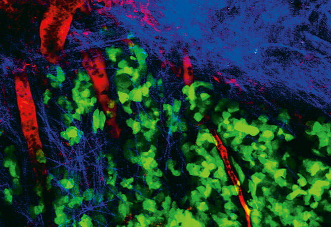 In vivo imaging of the tumor microenvironment in breast cancer
