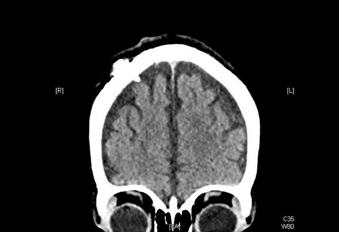 Coronal CT of the brain demonstrating an Ommaya reservoir adjacent to the right frontal lobe.