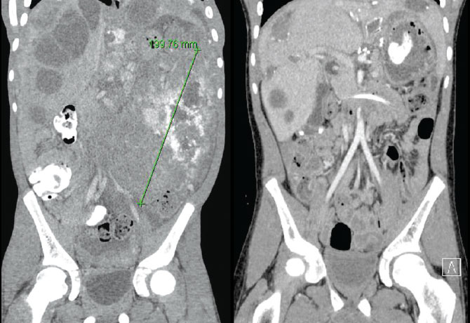 Left: CT scan images taken at the time of diagnosis showing an extremely high intra-abdominal tumor burden with involvement of multiple organs. Right: CT scan images taken after induction chemotherapy and extensive surgical resection that also involved the administration of hyperthermic intraperitoneal chemoperfusion showing a significant reduction in the intra-abdominal tumor burden.