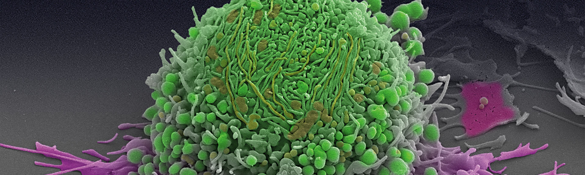 A photo of a prostate cancer cell prepared in the William Oh, MD, laboratory. Andrew P. Leonard, photo.