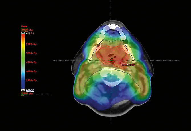 A computer-generated image depicts a standard, high-dose intensity modulated radiation therapy (IMRT) treatment plan for base of tongue cancer.