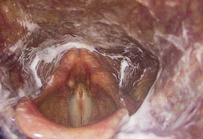 SEES appearance of larynx after sip and swallow of barium showing position of residue. 