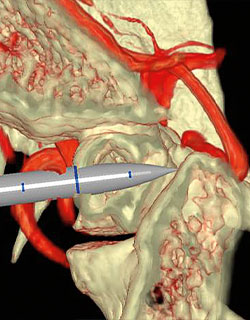 Surgical Theater 3D reconstruction image with neuronavigation.
